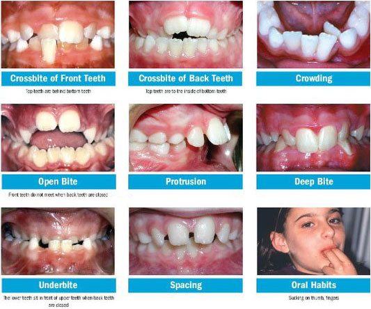 early-orthodontics