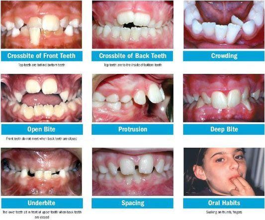 Early Orthodontics