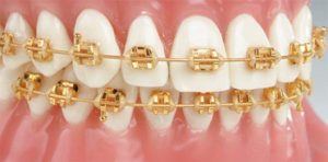 Gold Braces