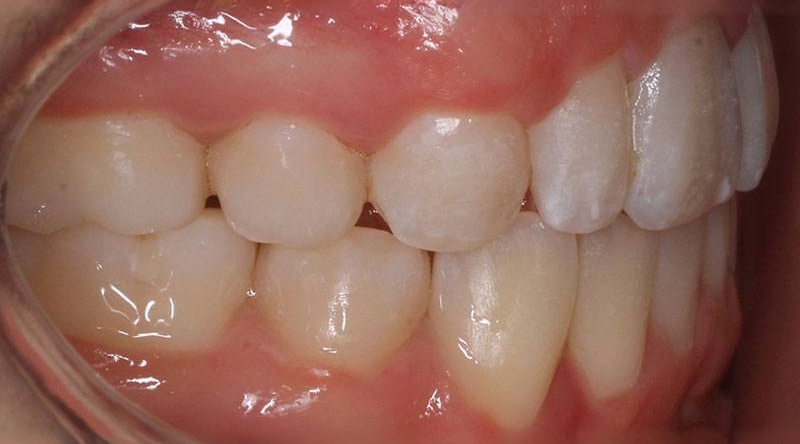After treatment - patient 37