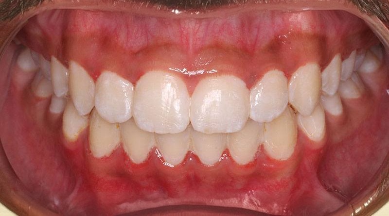 Before treatment - patient 32