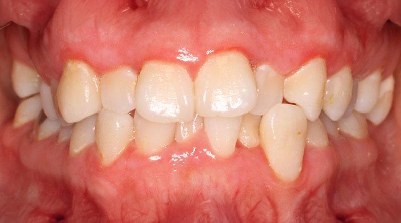 Before treatment - patient 1