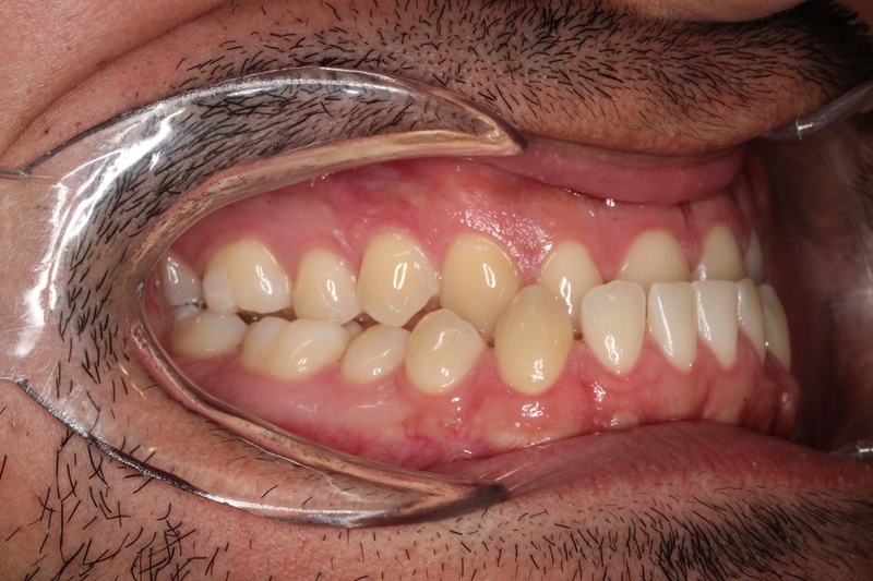 Before treatment - patient 100