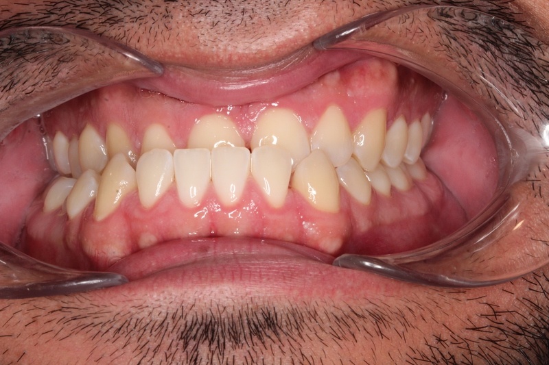 Before treatment - patient 101