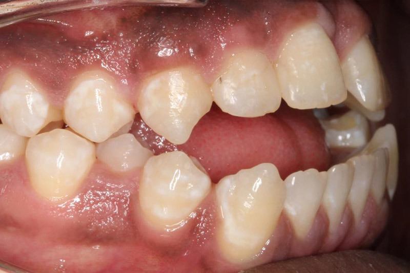 Before treatment - patient 103