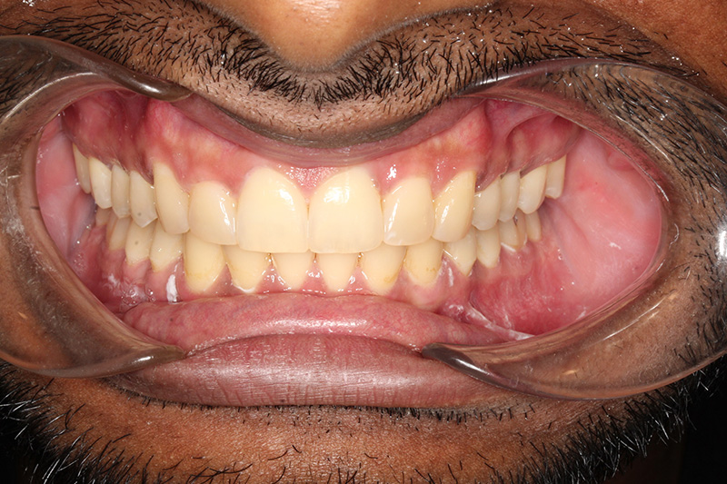 After treatment - patient 104