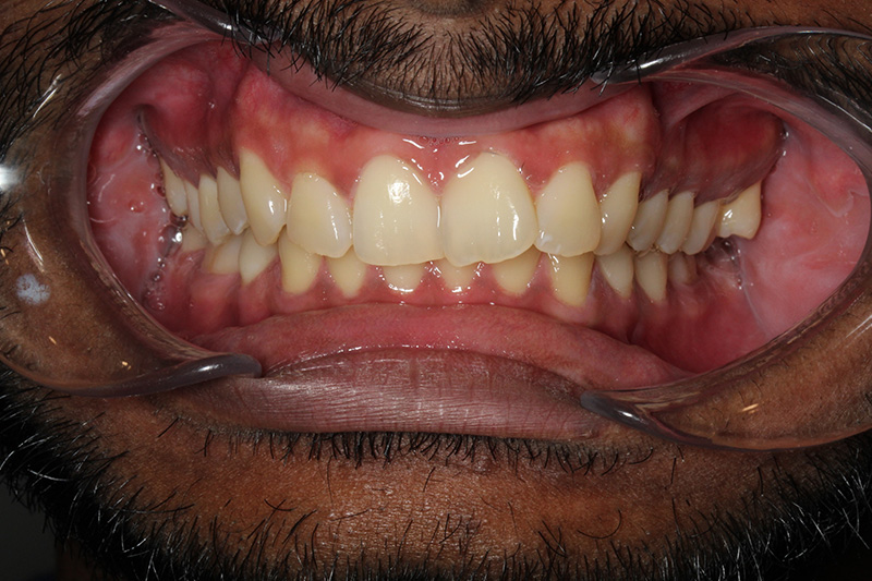 Before treatment - patient 104