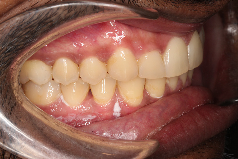 After treatment - patient 105