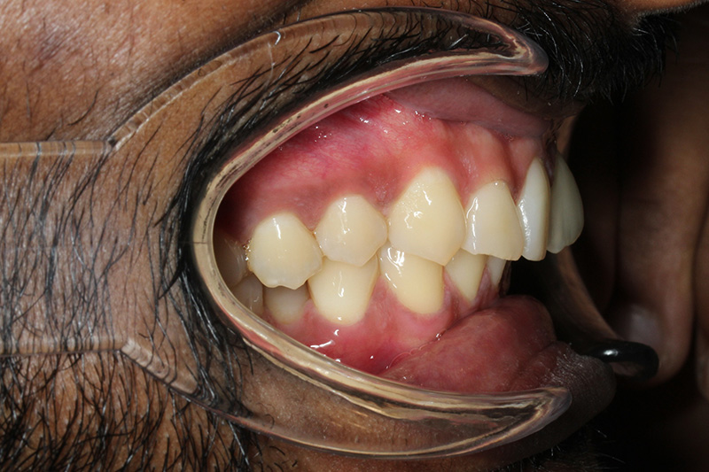 Before treatment - patient 105