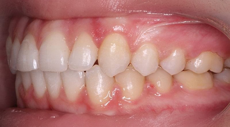 After treatment - patient 12