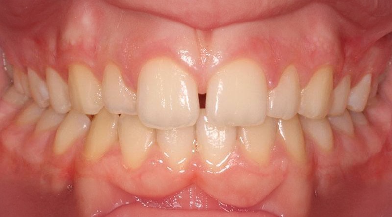 Before treatment - patient 22