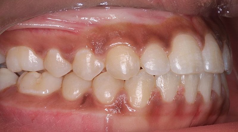 After treatment - patient 26