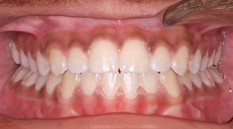 After treatment - patient 25