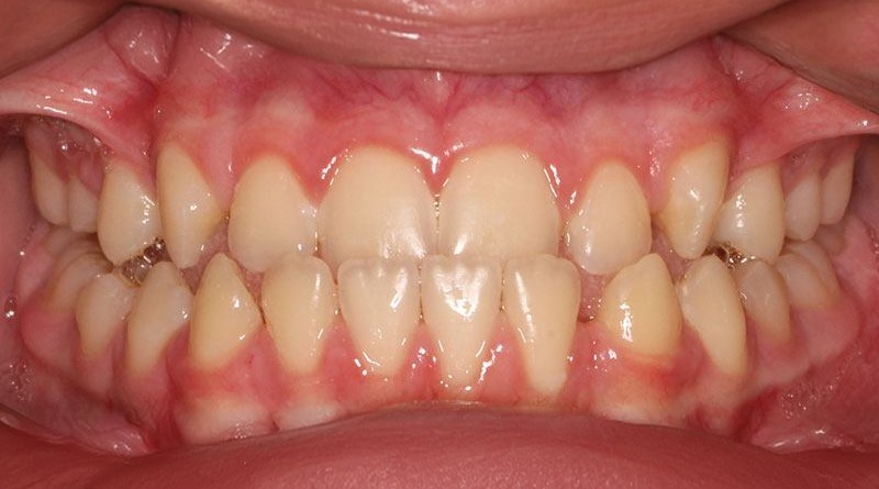 Before treatment - patient 20