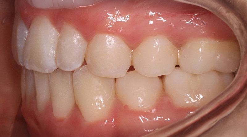 After treatment - patient 38