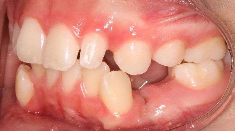 Before treatment - patient 38