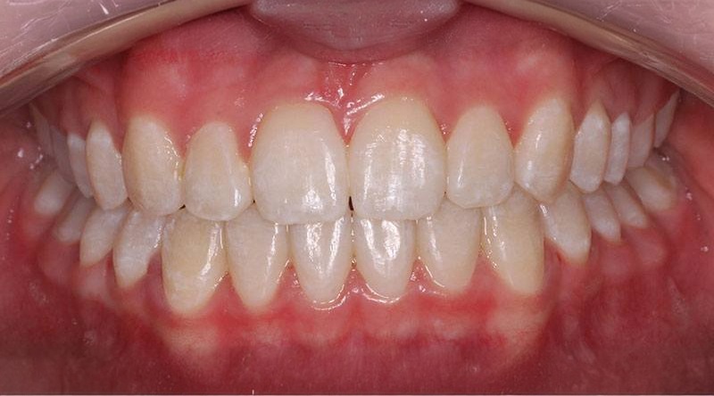 After treatment - patient 29