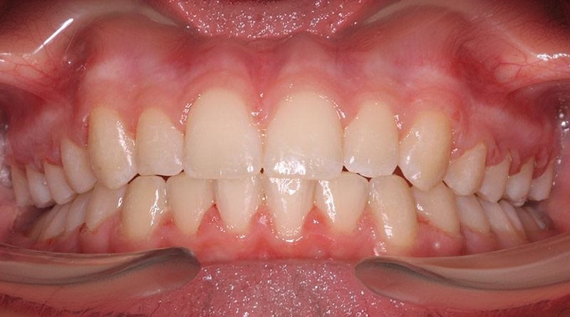 After treatment - patient 39
