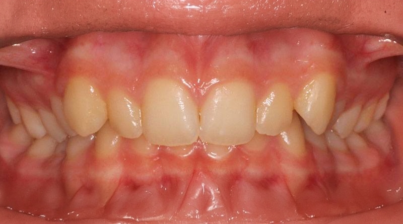Before treatment - patient 39