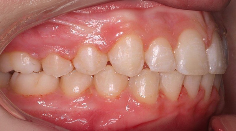 After treatment - patient 40
