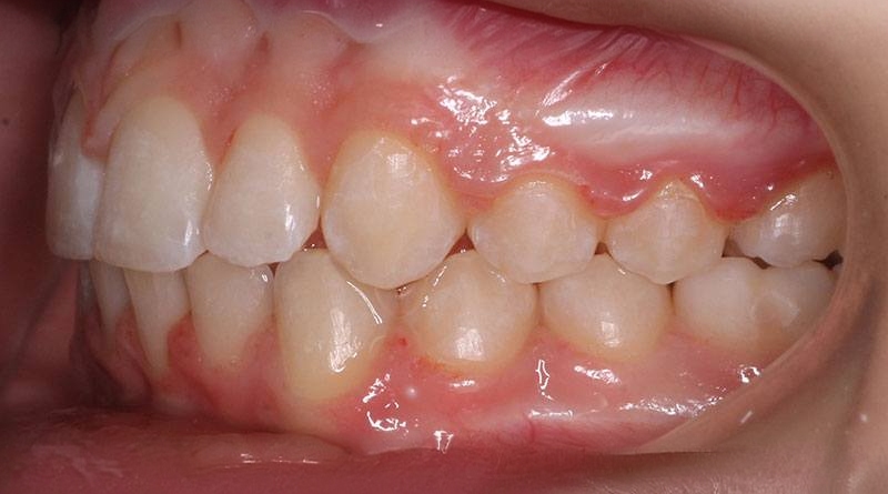 After treatment - patient 41