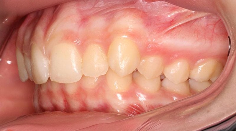 Before treatment - patient 41