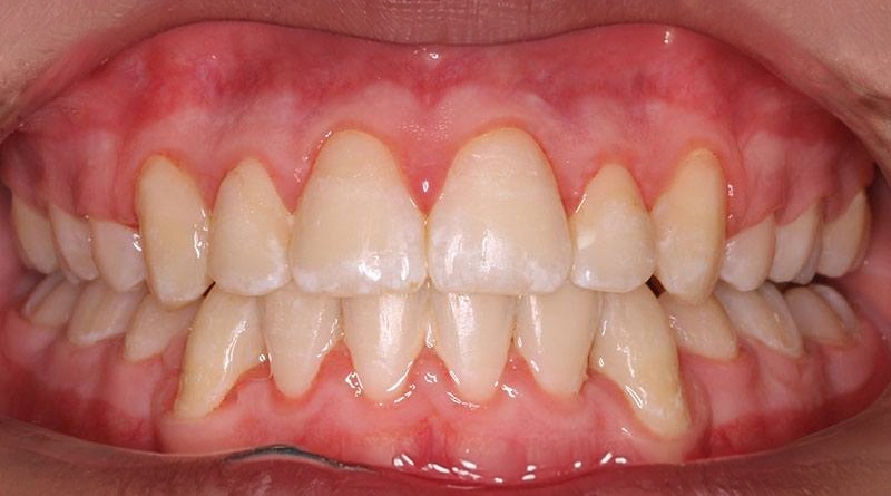 After treatment - patient 42