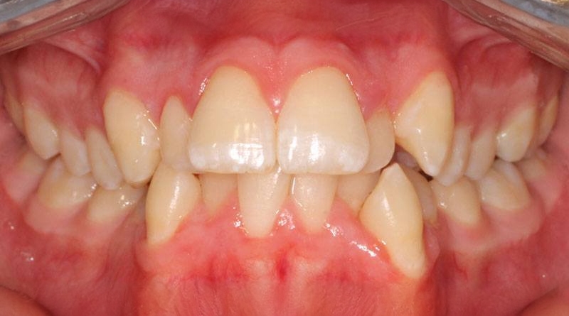 Before treatment - patient 42