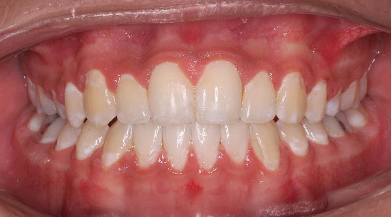 After treatment - patient 43