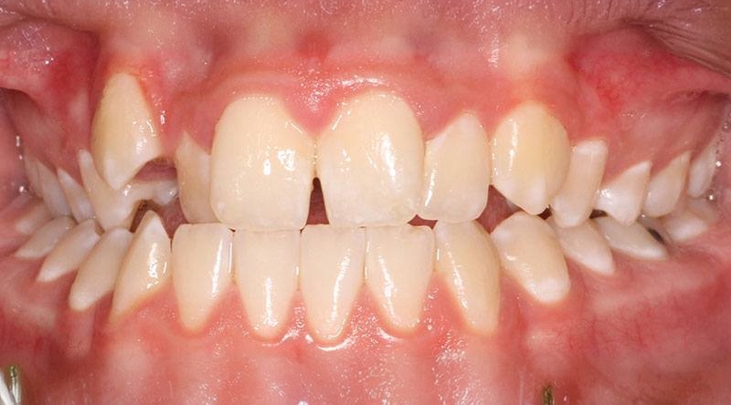 Before treatment - patient 43