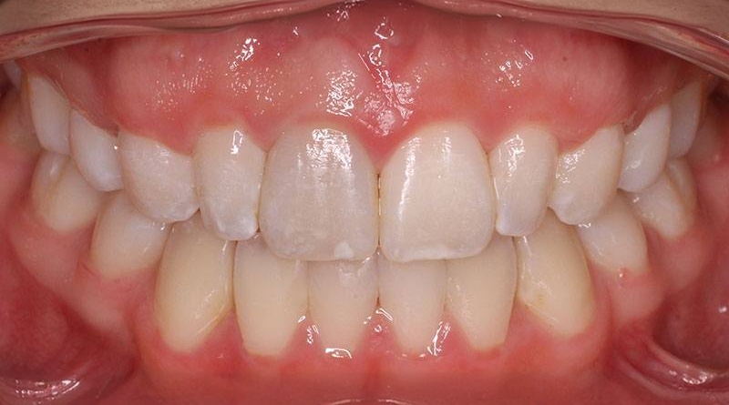 After treatment - patient 44