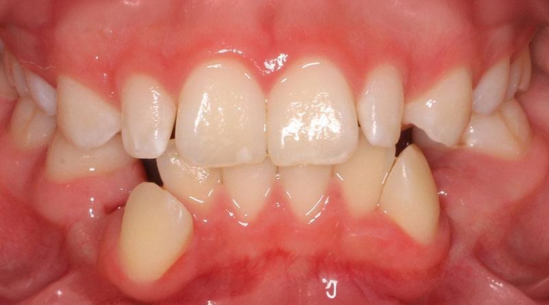 Before treatment - patient 44