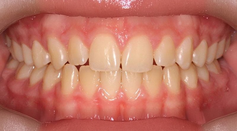 Before treatment - patient 13