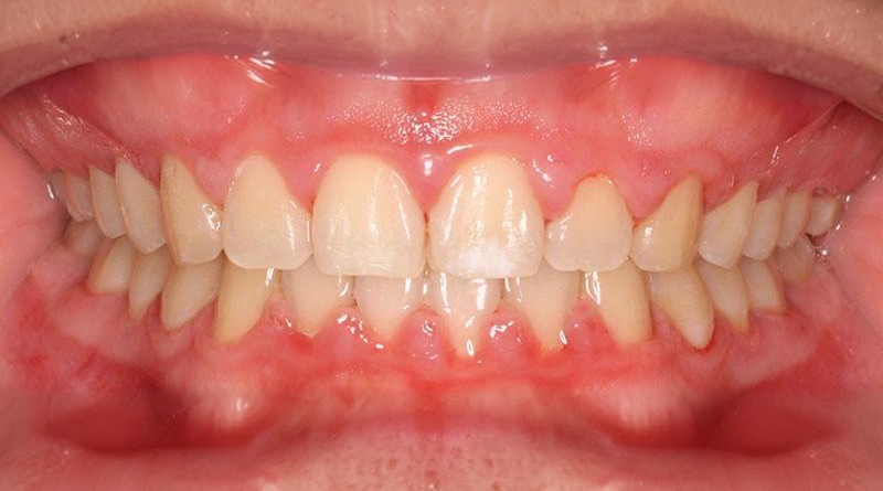 After treatment - patient 17