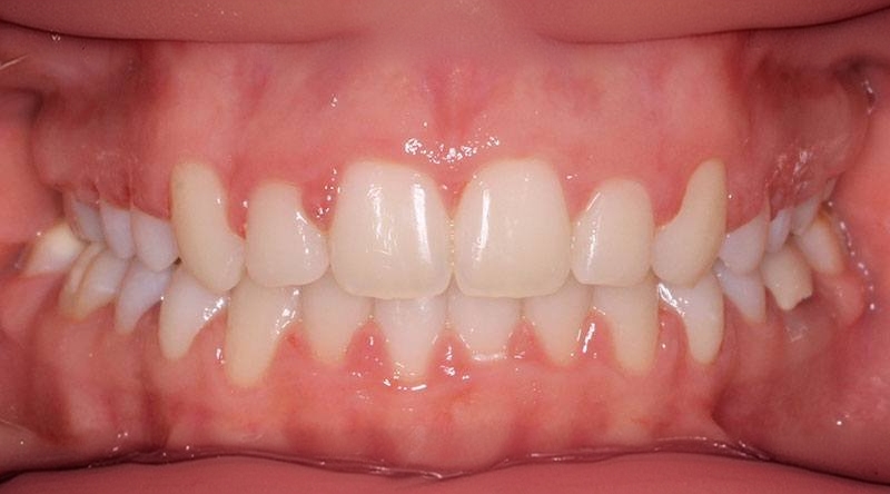 After treatment - patient 46