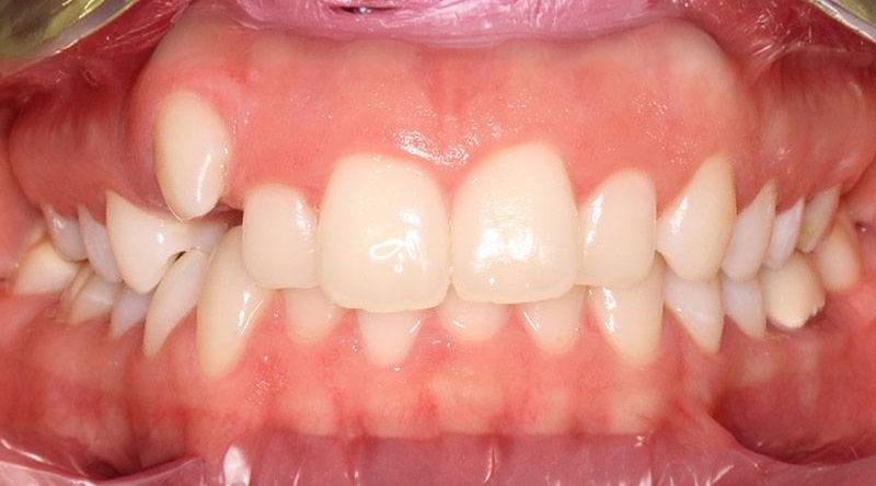 Before treatment - patient 46