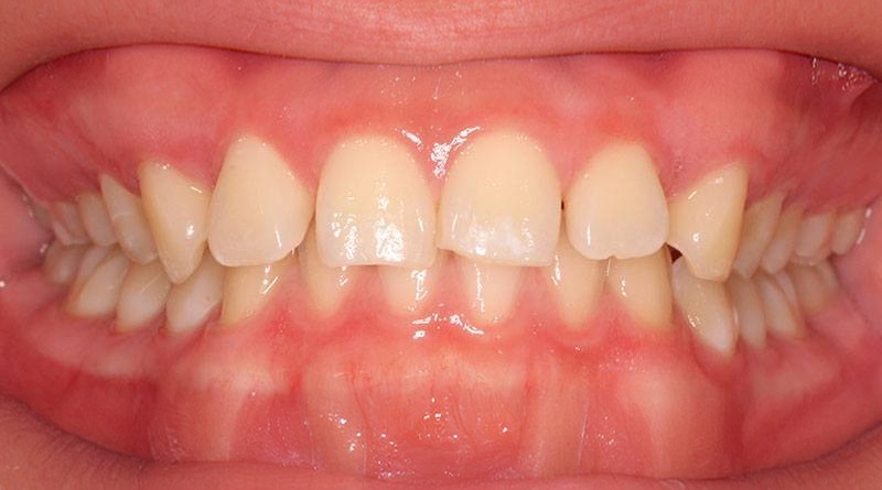 Before treatment - patient 17