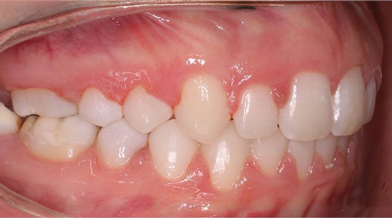 After treatment - patient 47