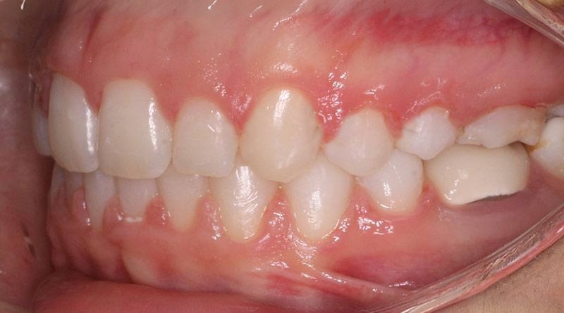 After treatment - patient 48