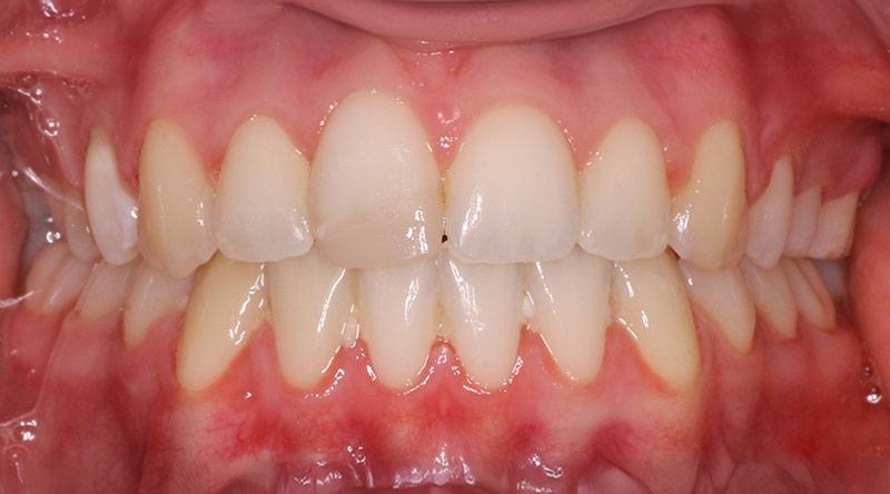 After treatment - patient 49