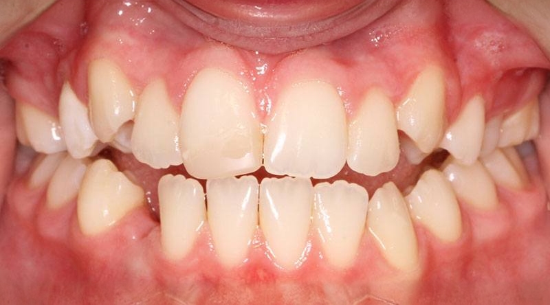 Before treatment - patient 49