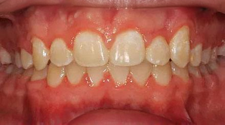 After treatment - patient 50