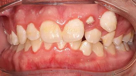 Before treatment - patient 50