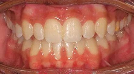 After treatment - patient 51