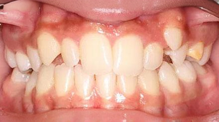 Before treatment - patient 51