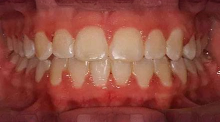 After treatment - patient 52