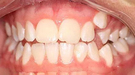 Before treatment - patient 52