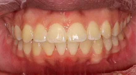 After treatment - patient 53