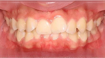 Before treatment - patient 53