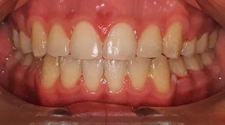 After treatment - patient 54